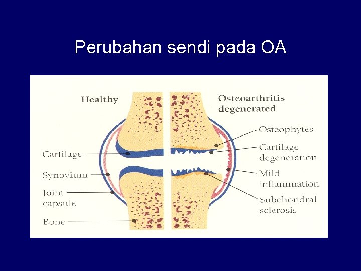 Perubahan sendi pada OA 