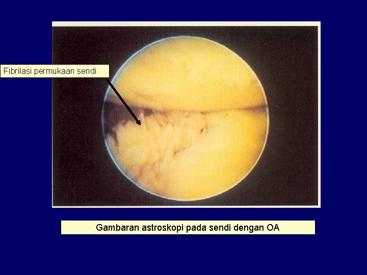 Fibrilasi permukaan sendi Gambaran astroskopi pada sendi dengan OA 