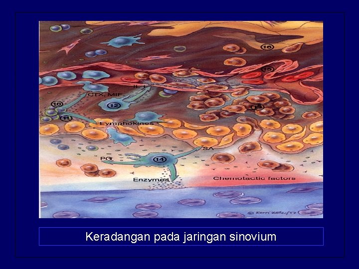 Keradangan pada jaringan sinovium 