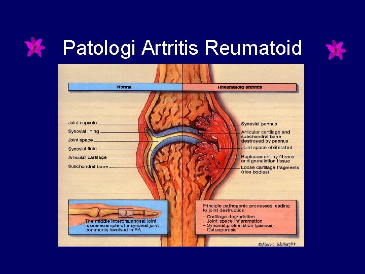 Patologi Artritis Reumatoid 