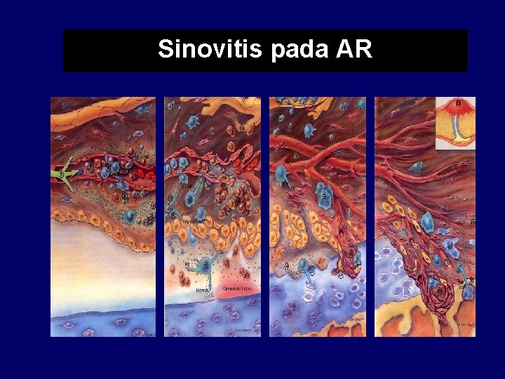 Sinovitis pada AR 