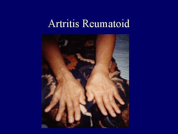 Artritis Reumatoid 