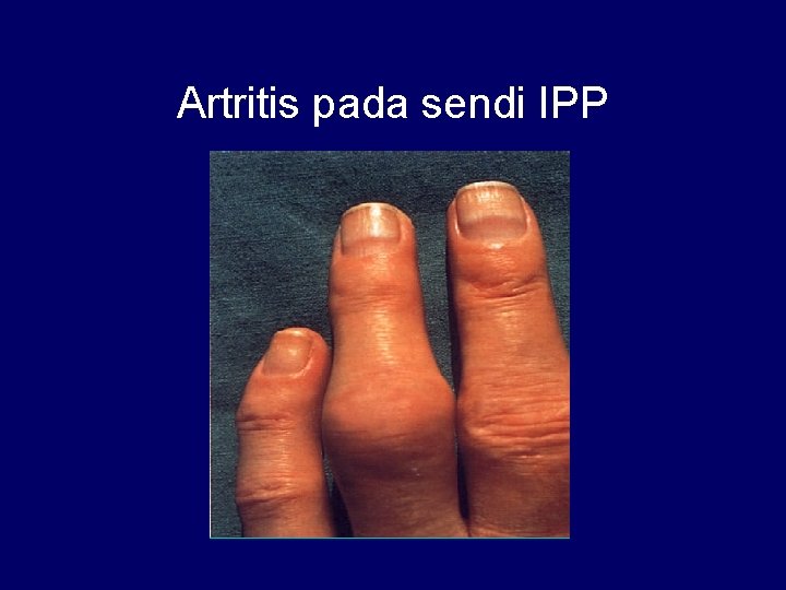 Artritis pada sendi IPP 