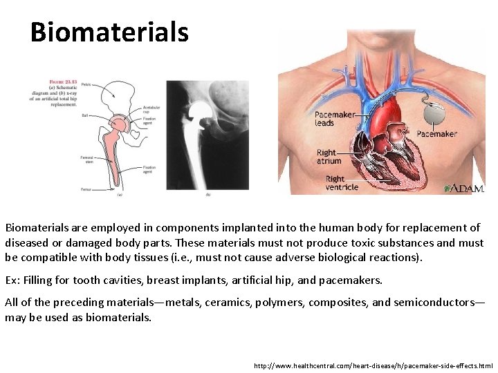 Biomaterials are employed in components implanted into the human body for replacement of diseased