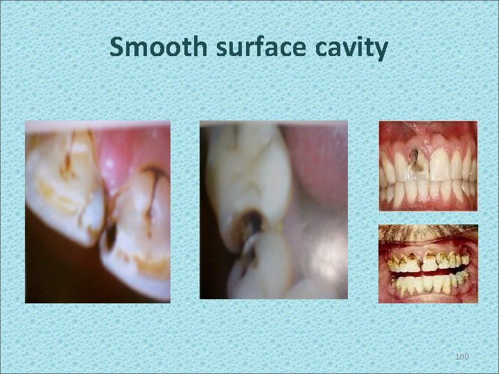 Smooth surface cavity 100 