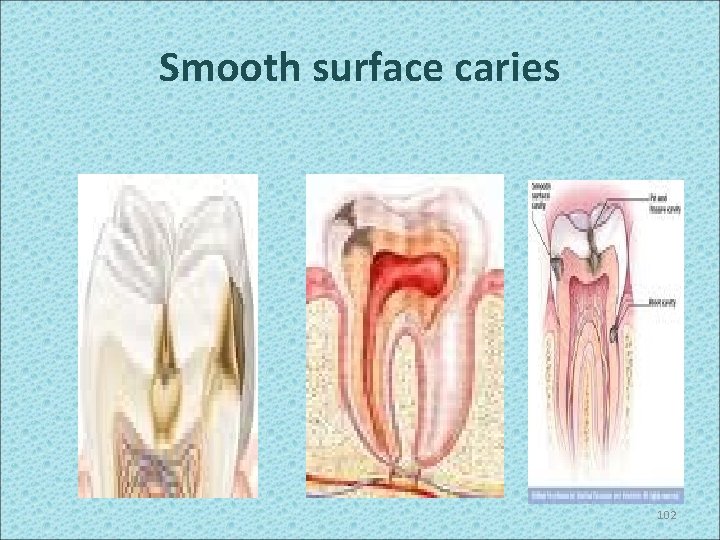 Smooth surface caries 102 