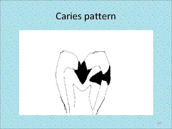 Caries pattern 103 