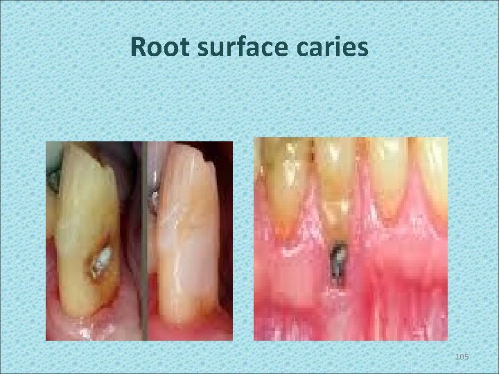 Root surface caries 105 