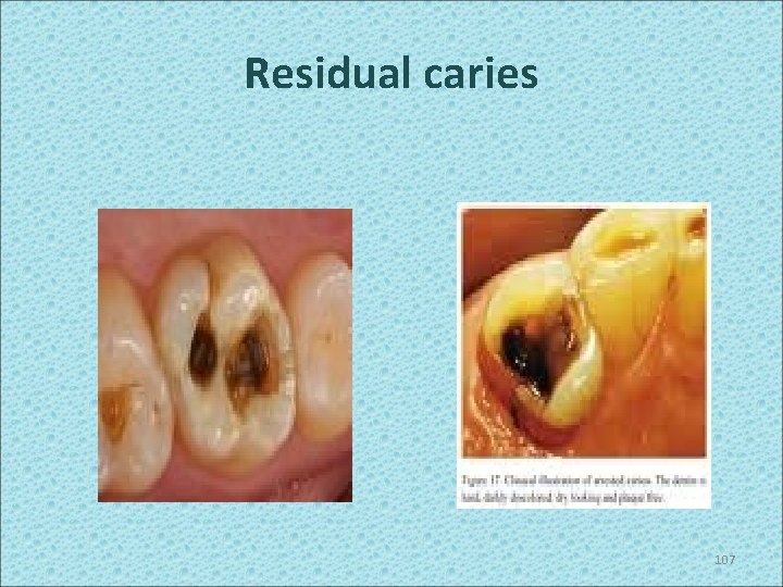 Residual caries 107 