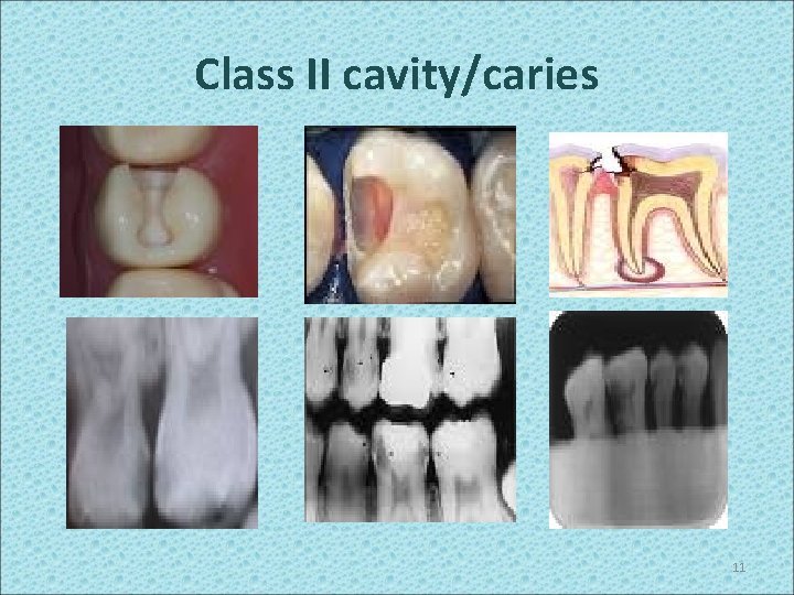 Class II cavity/caries 11 
