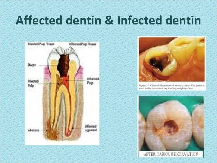 Affected dentin & Infected dentin 112 