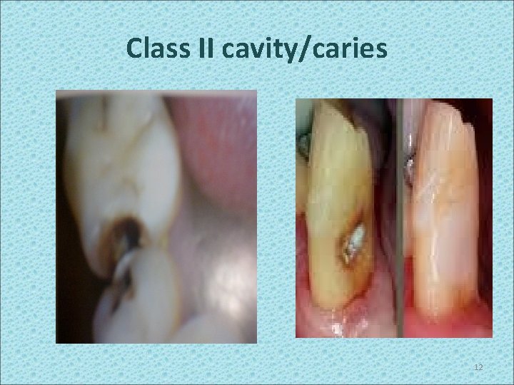 Class II cavity/caries 12 