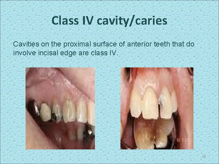 Class IV cavity/caries Cavities on the proximal surface of anterior teeth that do involve