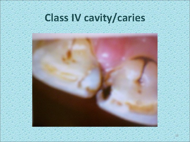 Class IV cavity/caries 16 