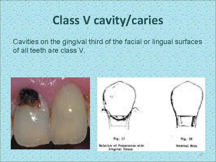 Class V cavity/caries Cavities on the gingival third of the facial or lingual surfaces