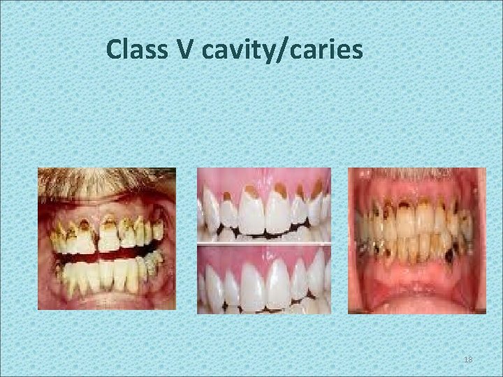 Class V cavity/caries 18 