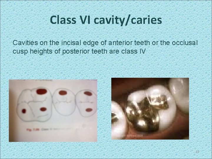 Class VI cavity/caries Cavities on the incisal edge of anterior teeth or the occlusal