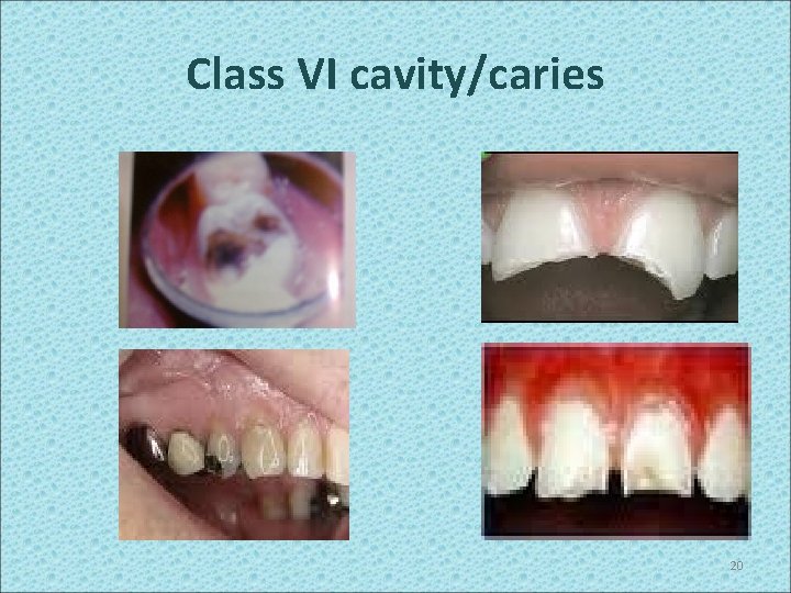 Class VI cavity/caries 20 