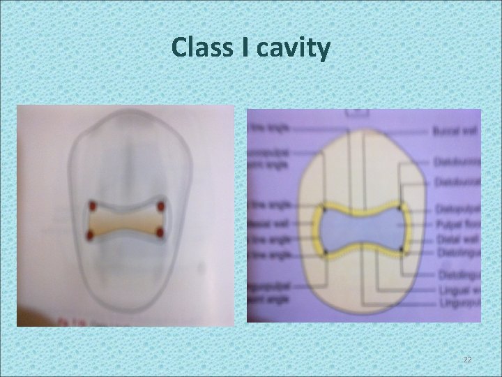Class I cavity 22 