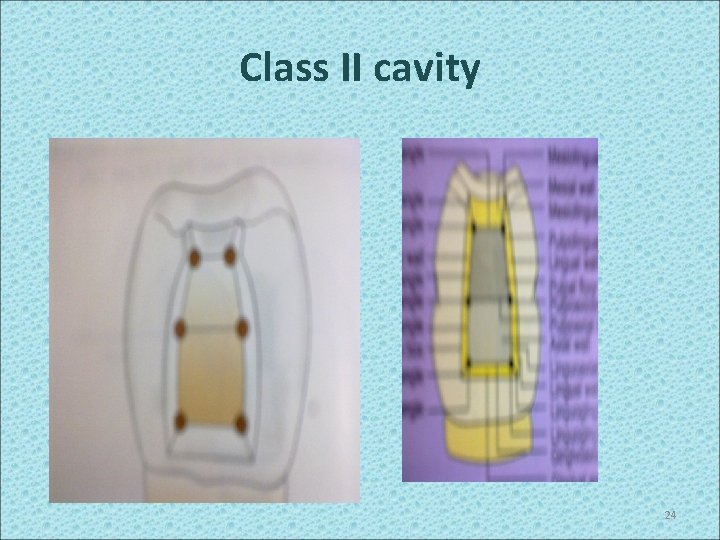 Class II cavity 24 