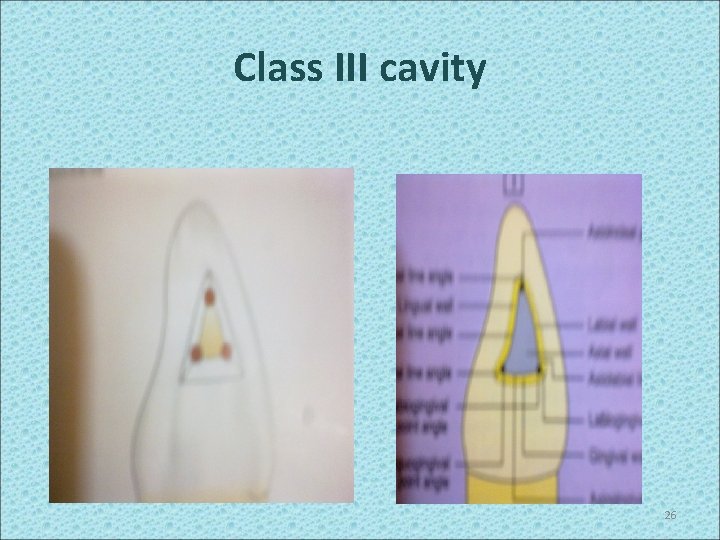 Class III cavity 26 