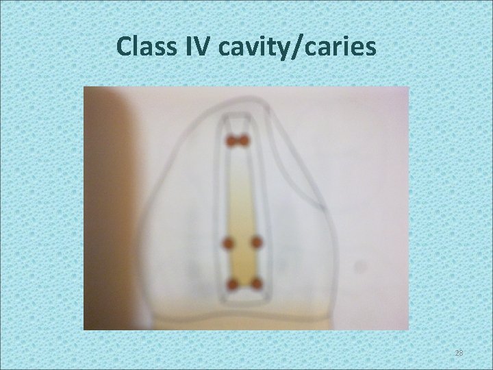 Class IV cavity/caries 28 