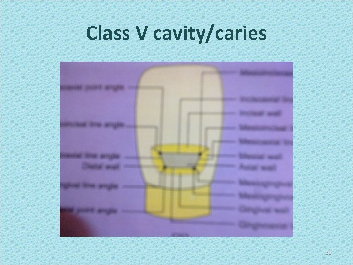 Class V cavity/caries 30 