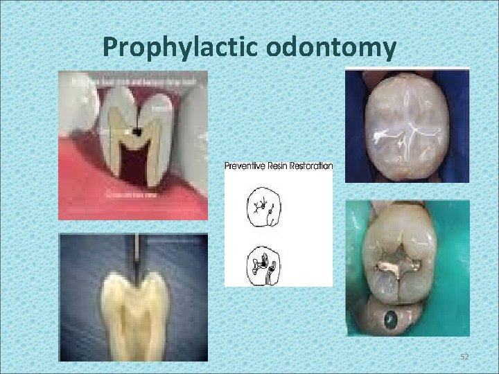 Prophylactic odontomy 52 