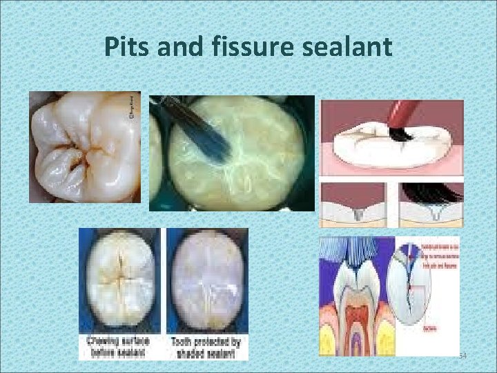Pits and fissure sealant 54 