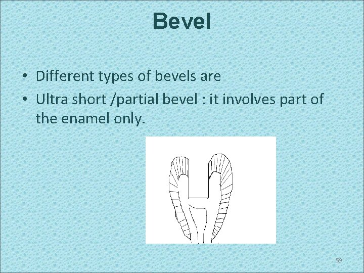 Bevel • Different types of bevels are • Ultra short /partial bevel : it