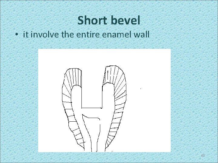 Short bevel • it involve the entire enamel wall 60 