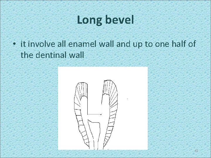 Long bevel • it involve all enamel wall and up to one half of