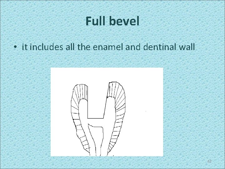 Full bevel • it includes all the enamel and dentinal wall 62 