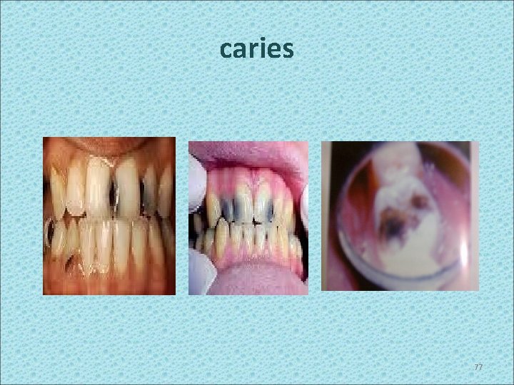 caries 77 