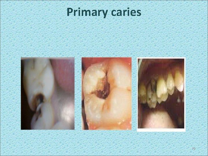 Primary caries 79 