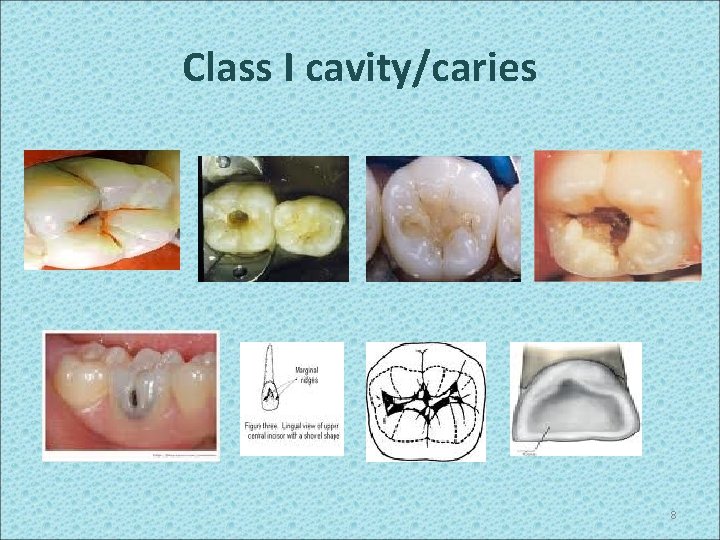 Class I cavity/caries 8 