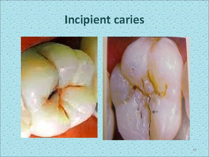 Incipient caries 83 