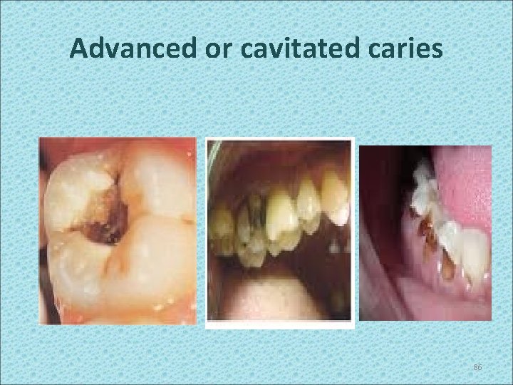 Advanced or cavitated caries 86 