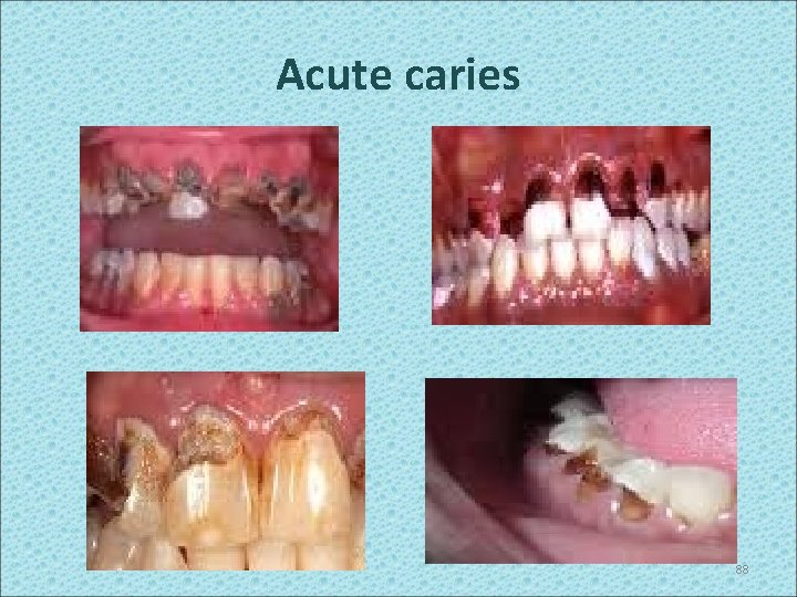 Acute caries 88 