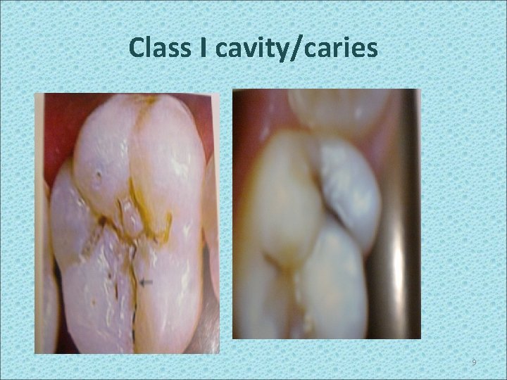 Class I cavity/caries 9 