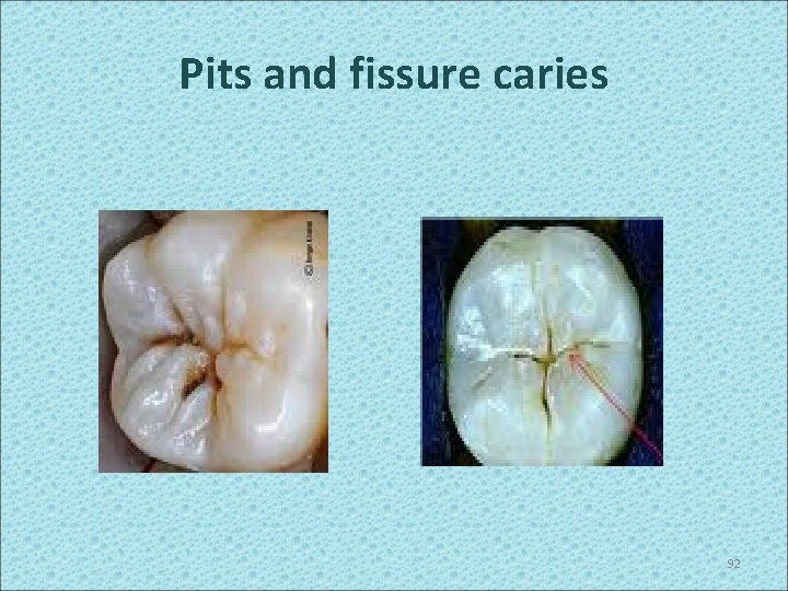Pits and fissure caries 92 