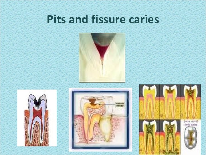 Pits and fissure caries 95 