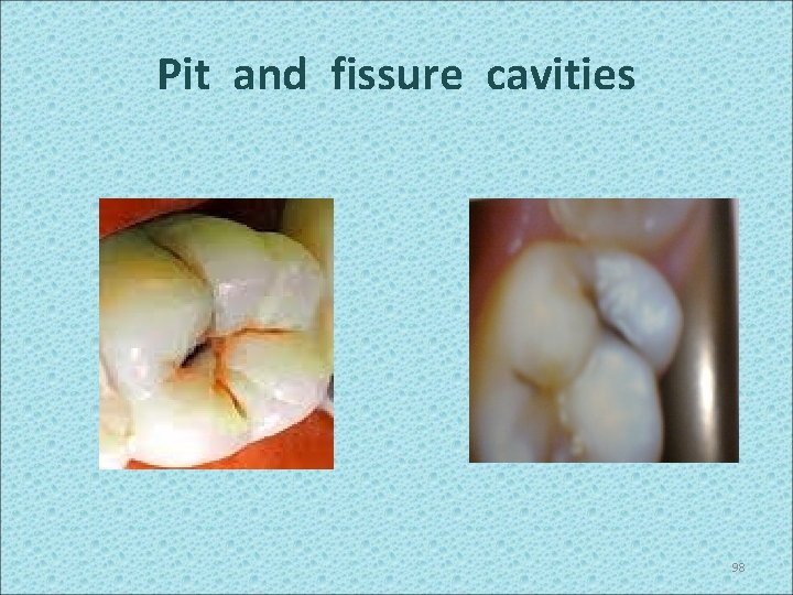 Pit and fissure cavities 98 