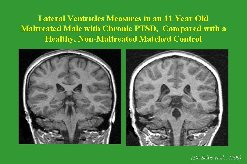 Lateral Ventricles Measures in an 11 Year Old Maltreated Male with Chronic PTSD, Compared