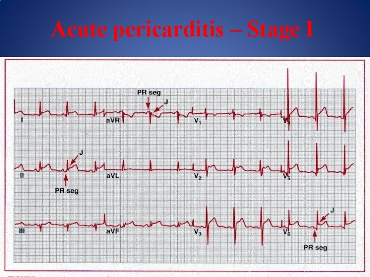 Acute pericarditis – Stage I 