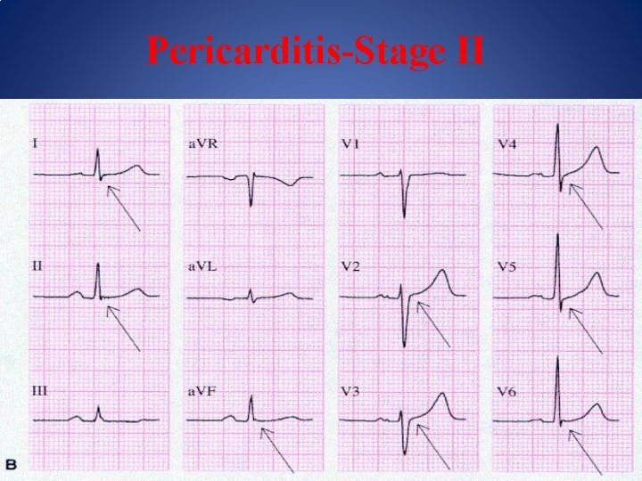 Pericarditis-Stage II 