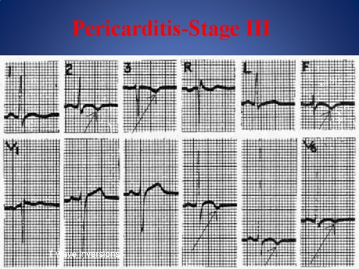 Pericarditis-Stage III T wave inversions 