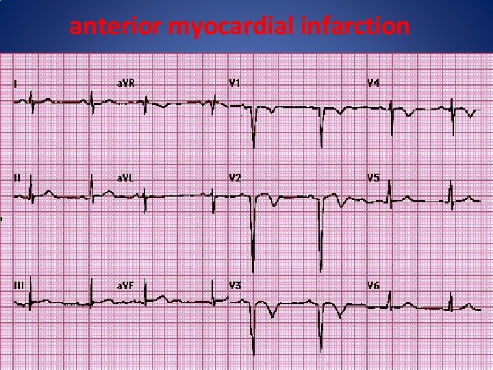 anterior myocardial infarction 