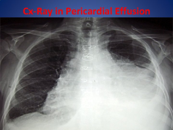 Cx-Ray in Pericardial Effusion 