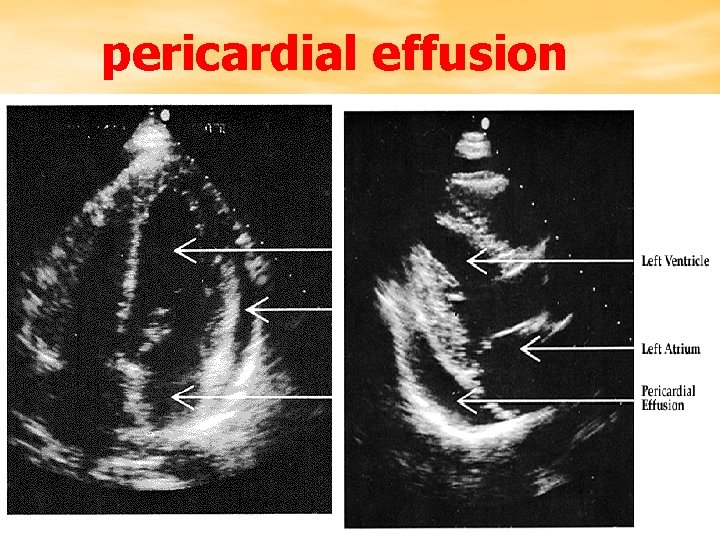 pericardial effusion 
